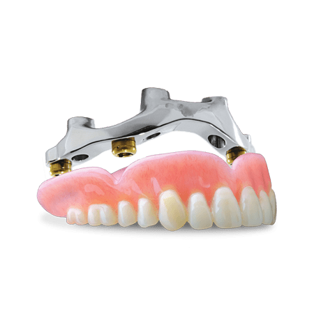 Implant-Retained Denture